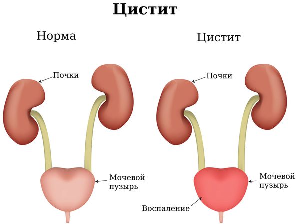 Цистит