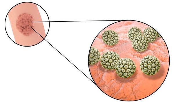 Вирус папилломы человека на коже