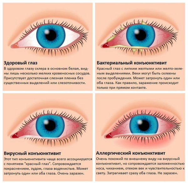 Конъюнктивит, виды