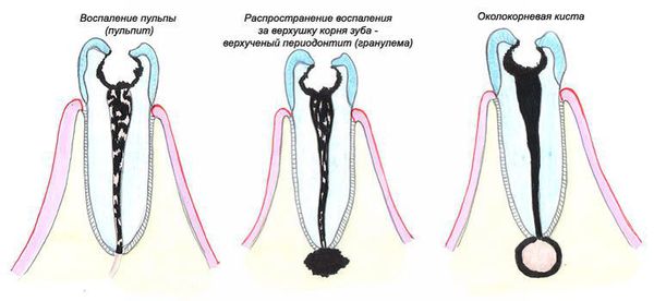 Формирование радикулярной кисты