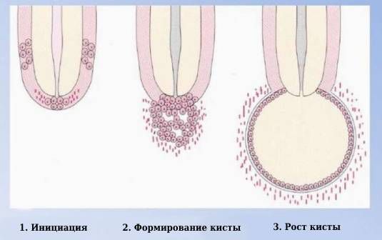 Стадии развития радикулярной кисты