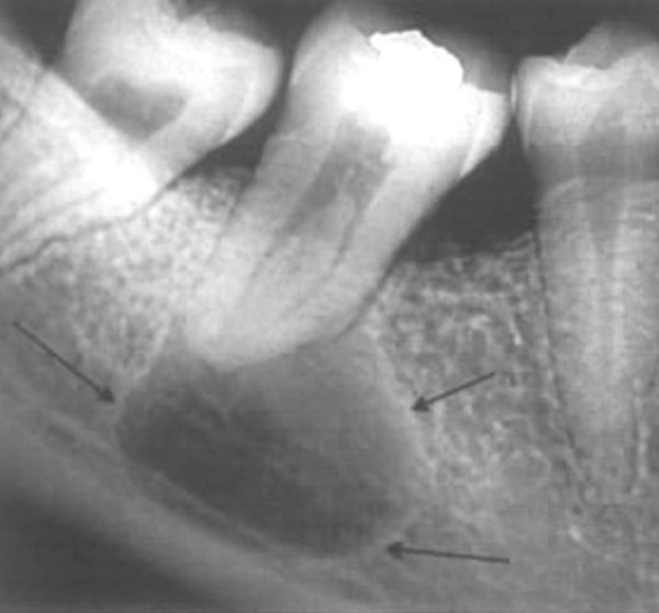 Радикулярная киста на рентгенограмме