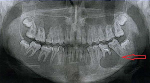 Радикулярная киста на ортопантомограмме