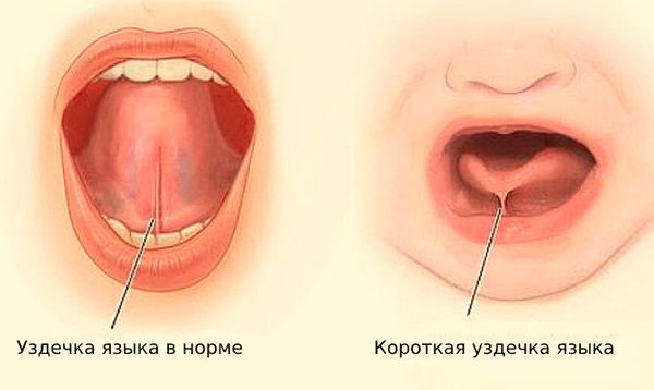 Короткая уздечка языка