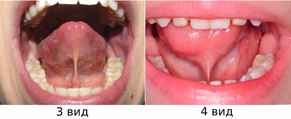 Классификация короткой уздечки языка 