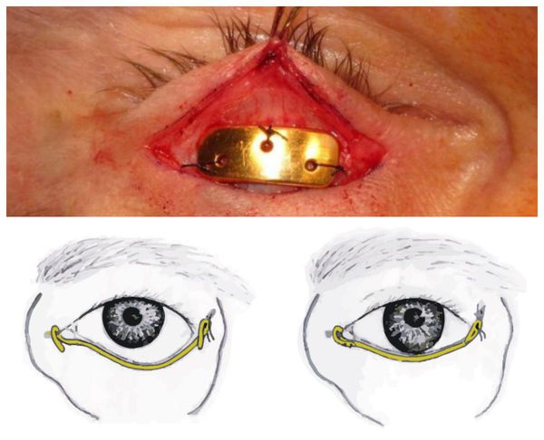 Вживление золотого импланта в верхнее веко и "подтягивание" нижнего века
