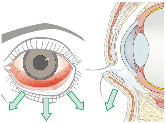 Слезотечение и покраснение при лагофтальме