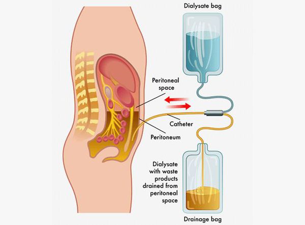 Перитонеальный диализ