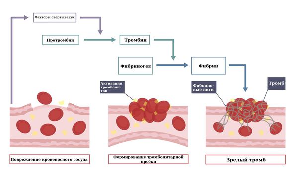 Образование тромба