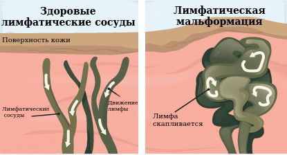 Здоровые лимфатические сосуды и лимфатическая мальформация