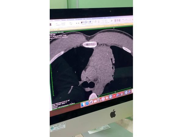 Срез КТ: большая лимфома средостения