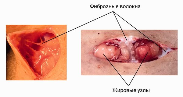 Фиброзные волокна 