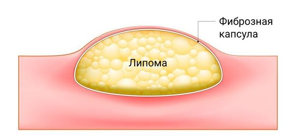 Липома