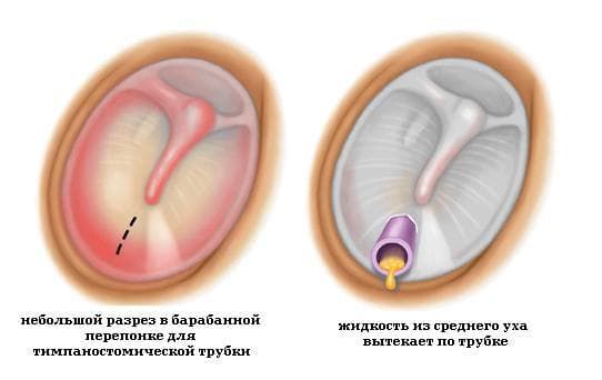 Парацентез