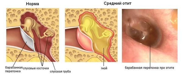 Средний отит