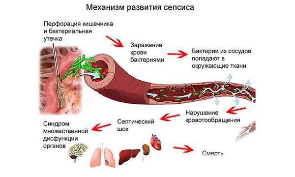 Механизм развития сепсиса