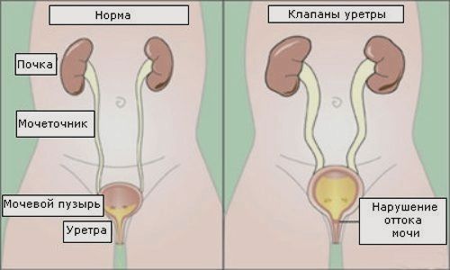 Клапан задней уретры