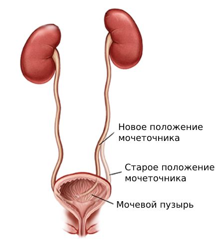 Реимплантация мочеточника