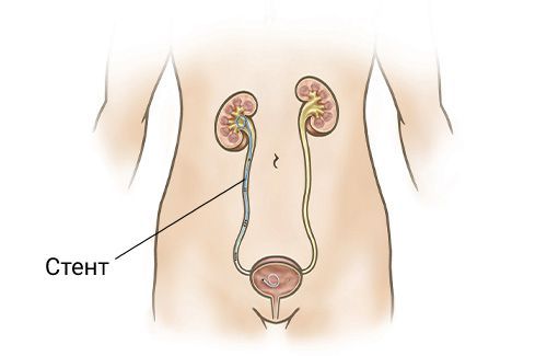Стентирование мочеточника