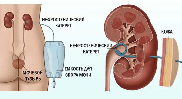 Чрескожная нефростома