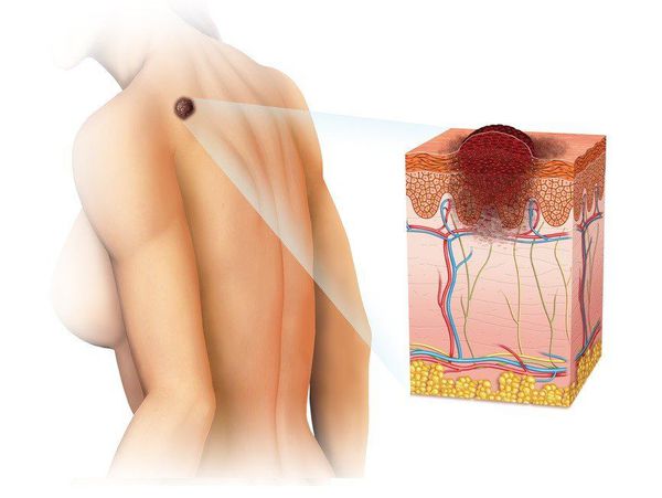 Злокачественная опухоль в виде меланомы