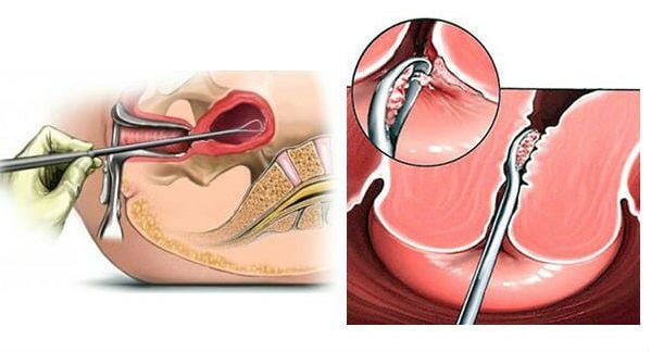 Выскабливание полости матки