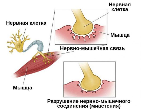 Разрушение нервно-мышечной связи