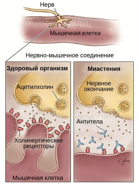 Нарушение нервно-мышечной связи