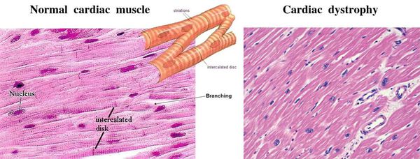 Дистрофия сердечной мышцы