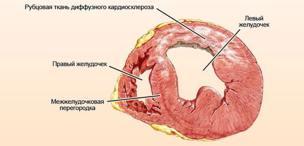 Образование рубцов в миокарде