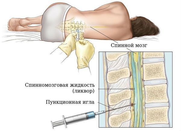 Люмбальная пункция