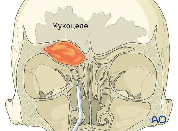 Мукоцеле﻿﻿ 