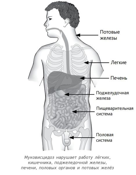 Нарушения в организме при муковисцидозе