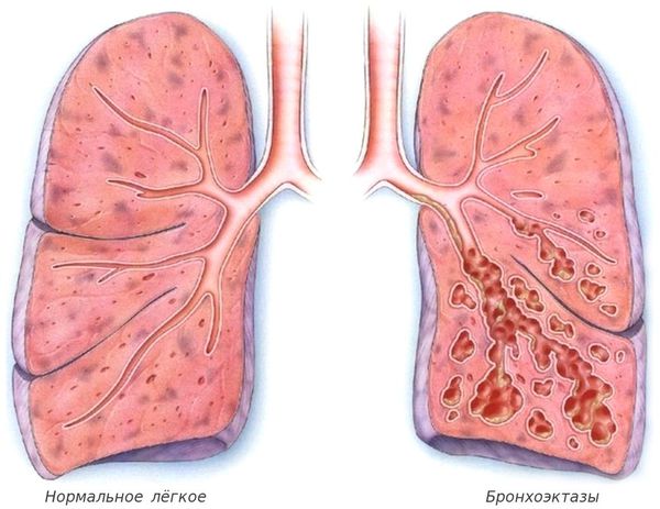 Нормальное лёгкое и бронхоэктазы 