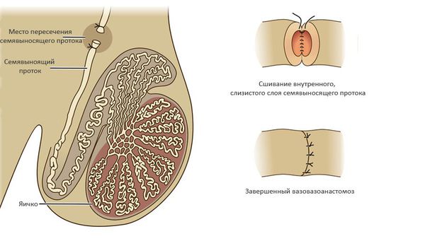 Вазовазоанастомоз