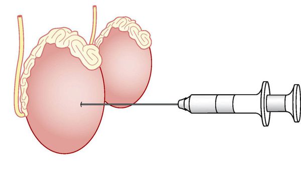 Тонкоигольная биопсия яичка