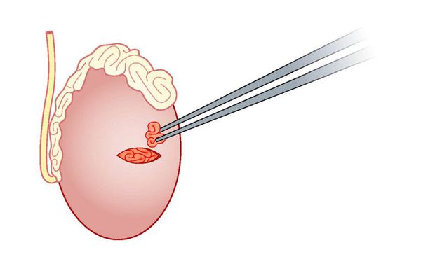 Открытая биопсия яичка