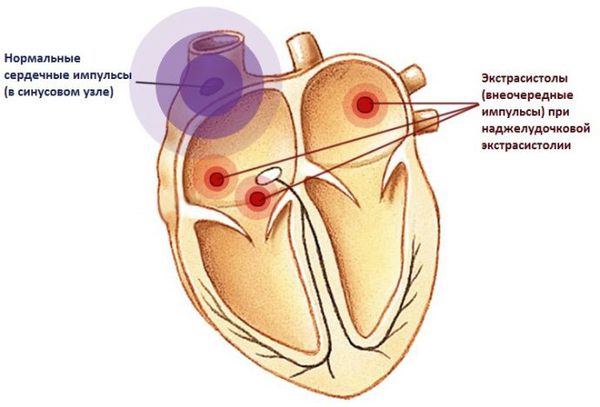 Внеочередные импульсы при наджелудочковой экстрасистолии