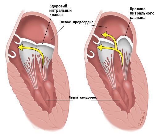 Пролапс митрального клапана
