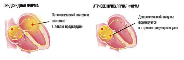 Предсердные и атриовентрикулярные преждевременные импульсы