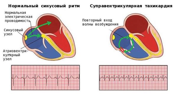 Суправентрикулярная тахикардия