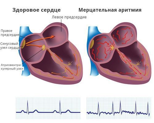 Мерцательная аритмия