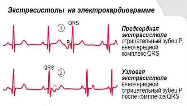 Наджелудочковые экстрасистолы на ЭКГ