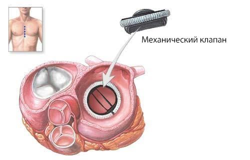 Протезирование клапана