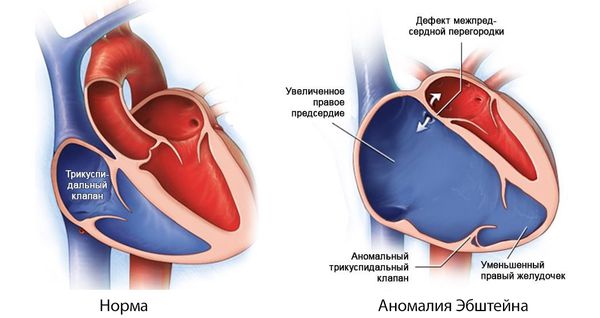 Аномалия Эбштейна