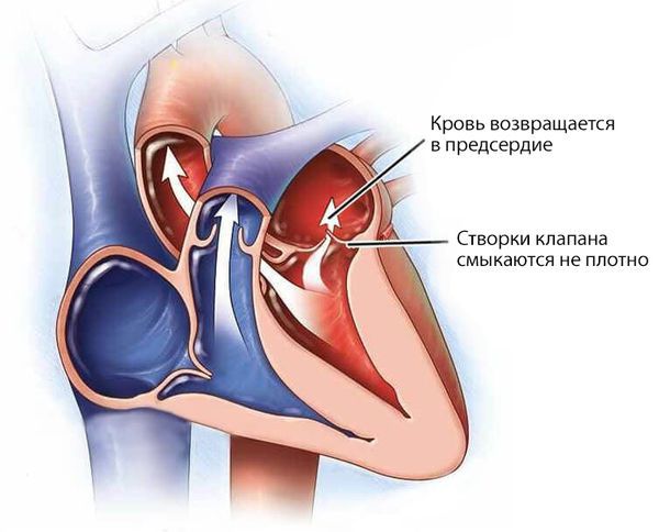 Недостаточность митрального клапана