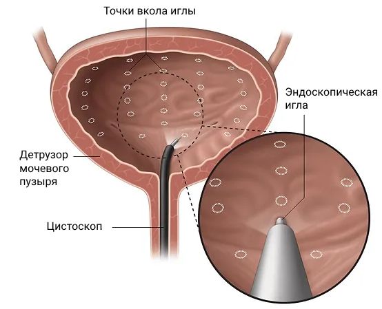 Внутридетрузорная инъекция ботулинического токсина