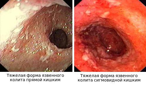 Эндоскопическая картина тяжёлых форм язвенного колита