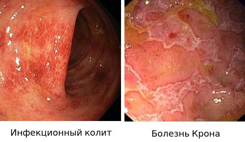 Болезни, которые следует отличать от язвенного колита