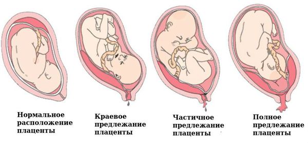 Предлежание плаценты